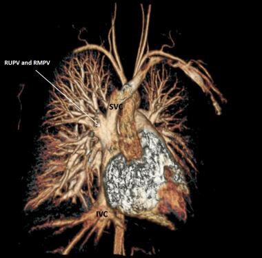 Partial anomalous pulmonary venous connection (PAP