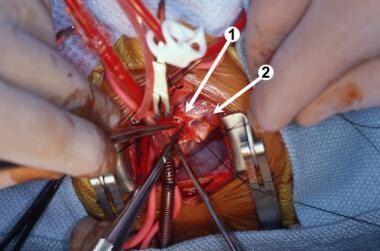 Intraoperative photograph. (1) Completing the anas