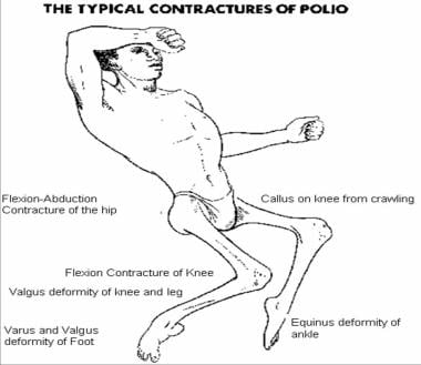 The typical contractures of postpolio residual par