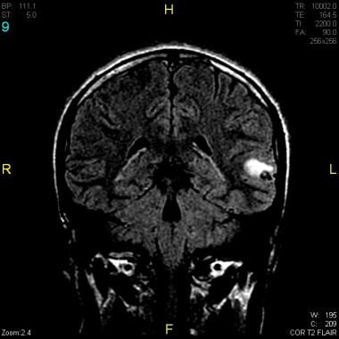 Brain MRI that reveals a cystic lesion containing 