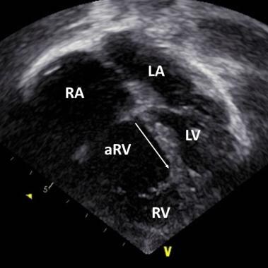Echocardiogram in an apical four-chamber view. Thi