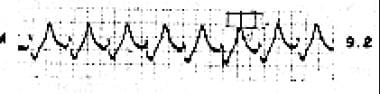 The tracing shows a wide QRS and very large T wave