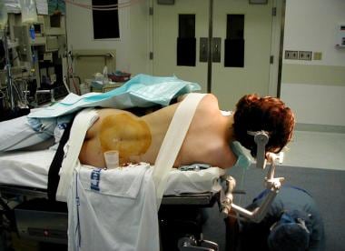 Patient positioned for lumbar drain insertion befo