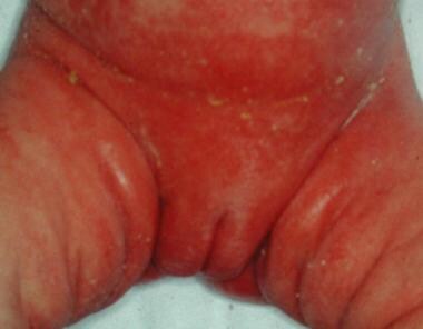 Benign vulvar lesions. Seborrheic dermatitis. 