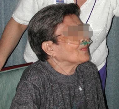 Pursed lip breathing is taught to patients with se