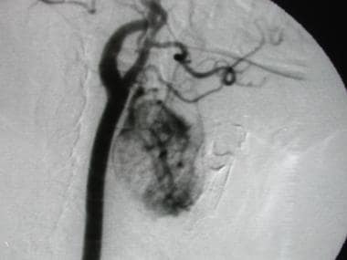 Angiogram in a patient who had a biopsy-proven ren