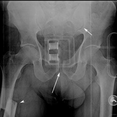 Motorcycle crash with open book injury. Radiograph