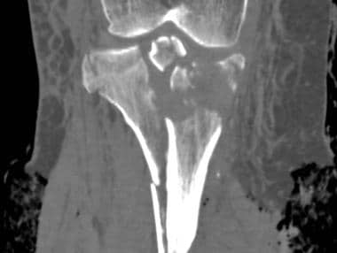 Tibial plateau fractures. Coronal reformatted CT. 