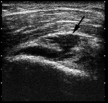 Shoulder, rotator cuff injury (ultrasonography). L