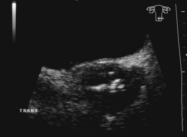 Transverse transabdominal sonogram of clinical sta