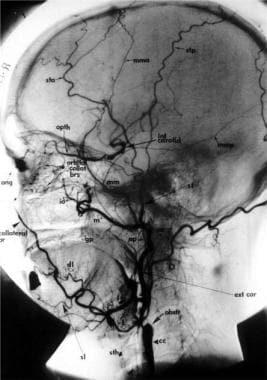 Lateral common carotid angiography demonstrates co