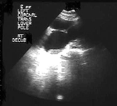 Sonogram of the kidney showing hydronephrosis with