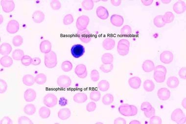 Peripheral smear taken from an 8-year-old Pakistan