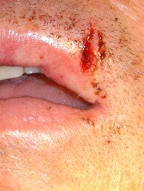 Lip laceration involving the upper vermilion borde