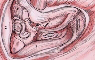 Right mastoid cavity landmarks. Note infralabyrint