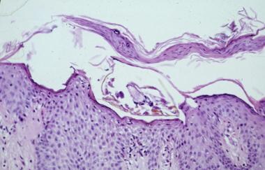 In routine scabies, a single mite is seen. Eosinop