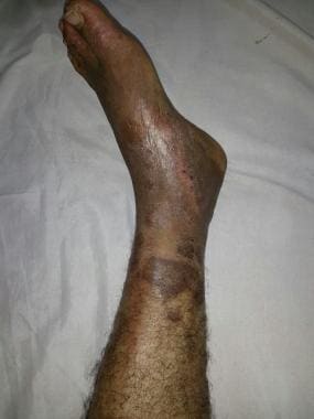 Postphlebitic limb in a Behçet disease patient. Co