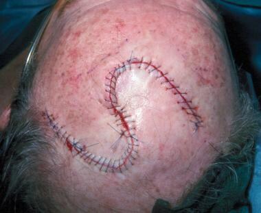 Postoperative appearance of the opposed rotation f