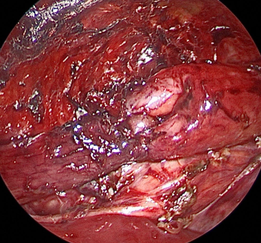 Posterior wall of anastomosis is completed. Interr