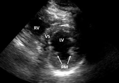 Ultrasound image of the parasternal short-axis vie