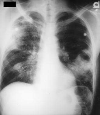 Chest radiograph of a patient with Rhodococcus equ