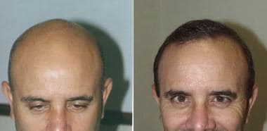 Case 2. Views before and after 3500 follicular-uni