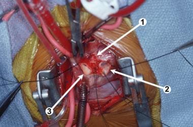 Intraoperative photograph. (1) The completed anast