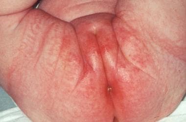 Irritant diaper dermatitis - Wikipedia