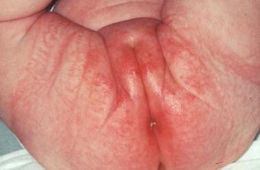 Candidiasis - Wikipedia