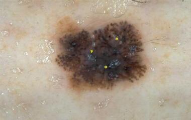 Microinvasive melanoma with pseudopods at the peri