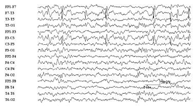 Electroencephalogram demonstrating benign rolandic