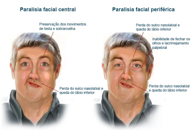 Paralisia De Bell Um Diagn stico Cl nico Com Um Tratamento Desafiador Paralisia De Bell Um Diagn stico Cl nico Com Um Tratamento Desafiador