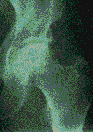 Steroid induced osteonecrosis hip