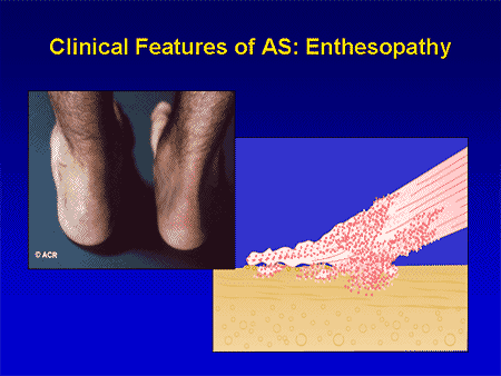 Treating Rheumatic And Other Inflammatory Diseases