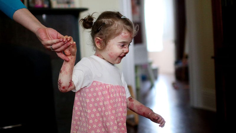 Birch Bark Derivative Effective for Epidermolysis Bullosa