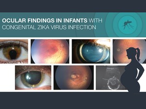 Ocular Findings in Congenital Zika Infection