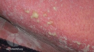 Oral IL-23 Blocker for Psoriasis Promising: Phase 2b Study