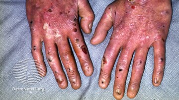 Topical Treatment for EB Recommended for Approval in the EU