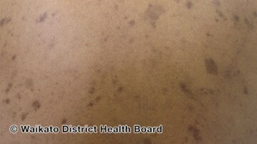 PIH in Black Patients Responds to Laser Treatment: Case Series