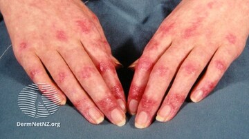 Lenabasum Improved Skin Symptoms, in Small Dermatomyositis Trial
