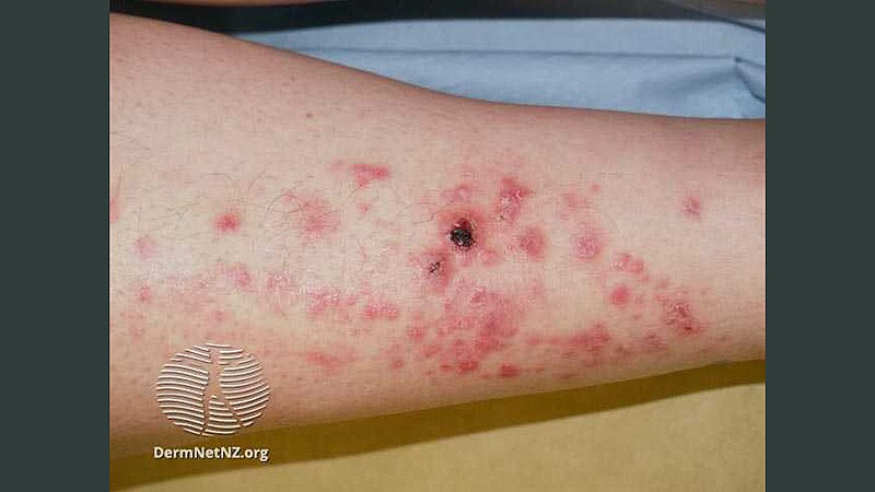 Progress Seen in Substantially Improving Treatment of EB