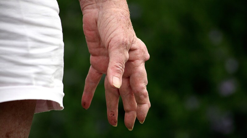 Chronic Inflammatory Diseases Vary Widely in CHD Risk