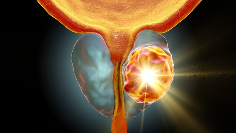 Positive Margins Post-Prostatectomy: Does Size Matter?