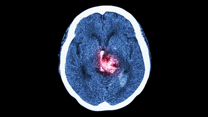 'Very High' Risk of Epilepsy 1 Year After Stroke 