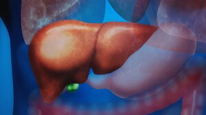 Liver Cancer Risk Lingers Even After HCV Eradication
