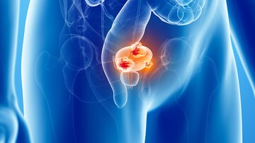 Overuse of Surveillance in Bladder Cancer, Despite Guidelines