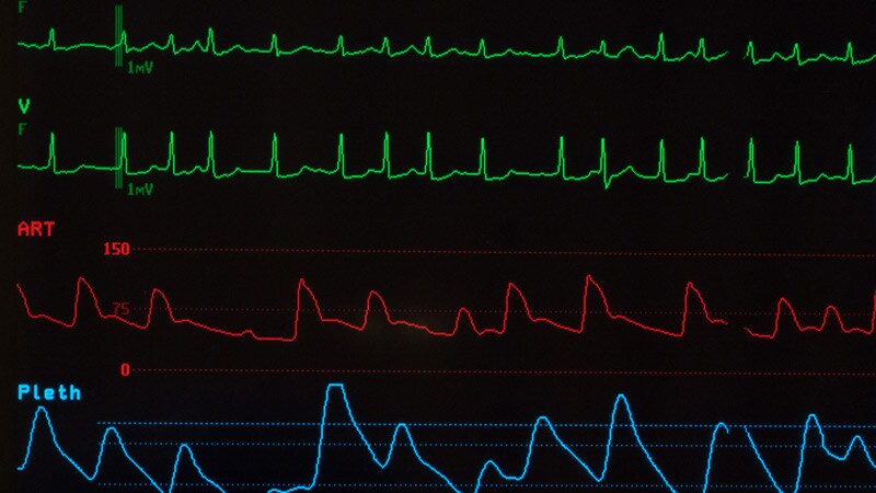 New Smart Device Shows Highly Accurate AF Detection: mAFA II  