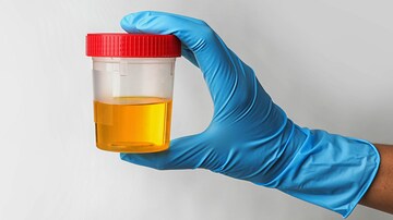 Value of Screening Urinalysis Prior to Office Procedures Questioned 
