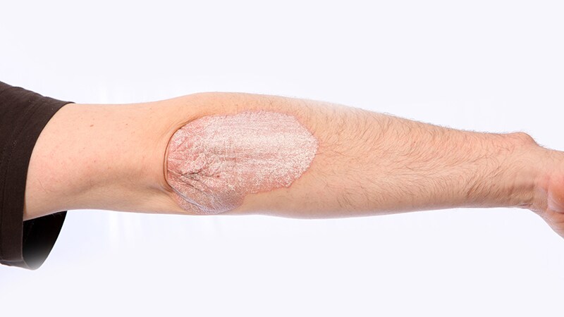 Vitamin D Deficiency Linked to Psoriasis Severity