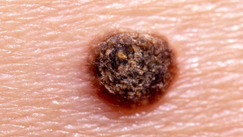 PLA Test Brings Nuance to the Diagnosis of Early-Stage Melanoma
